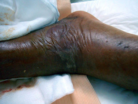 vi khuẩn ăn thịt