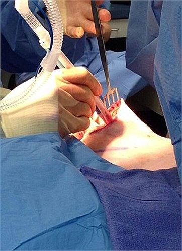 Trong ảnh là bác sĩ Minas Chrysopoulo và Steven Pisano, những người có chuyên môn cao trong việc tái tạo ngực cho bệnh nhân mắc ung thư, đang phẫu thuật cho chị Melissa Ray.