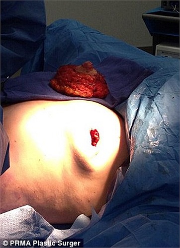 Được biết trước đó, mẹ của chị Mellisa đã tử vong vì căn bệnh ung thư vú. Theo các bác sĩ, quyết định cắt bỏ ngực của chị có thể giúp giảm đến 98% nguy cơ mắc bệnh ung thư. 