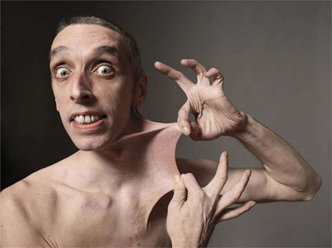 Garry Turner, đến từ Lincolnshire, Anh, đã kéo căng da cơ thể của mình để đạt kỷ lục chiều dài là 15,8 cm (6,25 in) vào ngày 29 tháng 10 năm 1999.