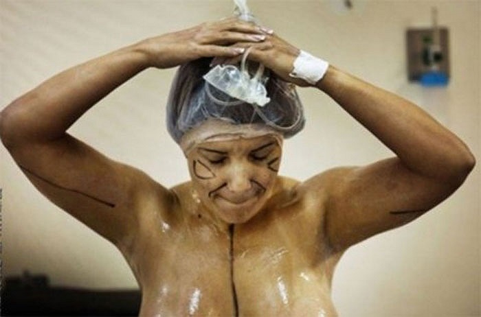 Một quý bà chuẩn bị cho hút mỡ không chỉ ở bụng mà còn ở cánh tay.