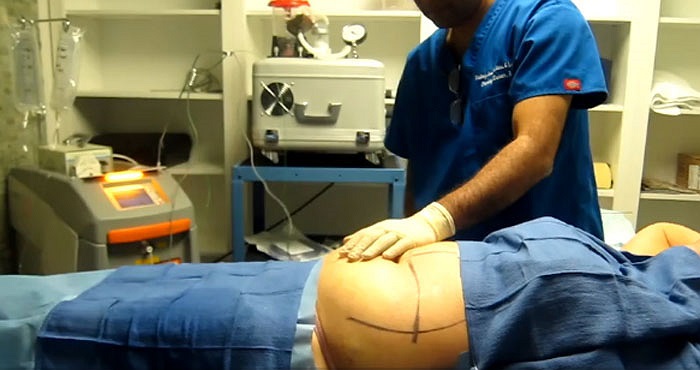 Và hút nội soi. Khi làm phẫu thuật này, bác sĩ sẽ đưa ống hút vào trong da bụng qua một lỗ nhỏ.