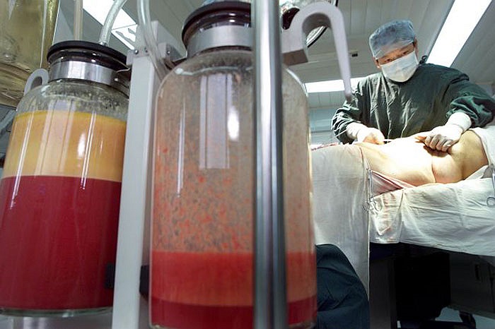 Trong bình là mỡ được hút ra khỏi bụng.