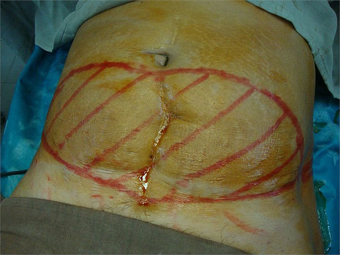 Bụng xẹp trông thấy sau khi được hút mỡ.