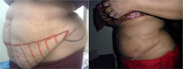 Hình ảnh bụng được cải thiện rõ ràng so với bụng trước khi hút mỡ.