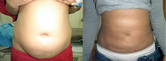 Bụng thon gọn hơn.