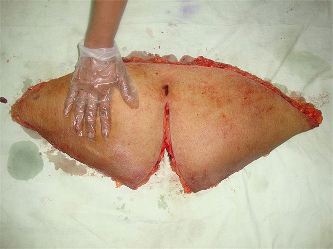 Đây là một phần da bụng cùng mô mỡ được loại bỏ.