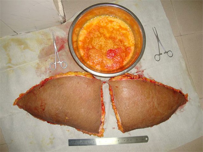 Bát bên cạnh là bát mỡ được hút ra từ bụng và eo của một bệnh nhân.