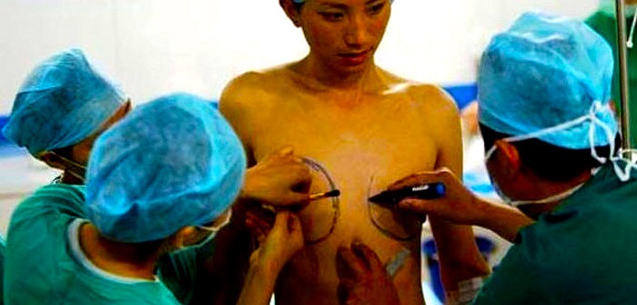 Nam thanh niên được các bác sĩ khoanh vùng tạo hình ngực nữ giới.