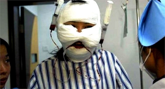 Phẫu thuật tạo hình khuôn mặt mới.