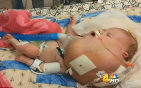 Khối u khổng lồ