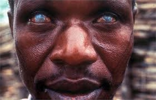 Mù lòa do rệp cắn: Đây là căn bệnh gây ra bởi một loại rệp và có thể khiến cho bệnh nhân bị mù lòa. Tuy không phải là một căn bệnh gây chết người nhưng nó có thể làm cho hàng triệu trường hợp vĩnh viễn mù.