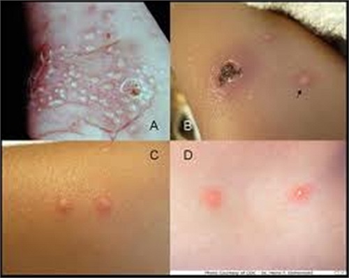 Dịch hạch do chuột: Bệnh lây truyền bằng đường máu qua một loại côn trùng đốt (bọ chét). Bọ chét thường sống ký sinh trên sóc, chuột, thỏ. Dịch hạch là một bệnh truyền nhiễm tối nguy hiểm, tiến triển cấp tính, lây lan mạnh với tỷ lệ tử vong cao. 