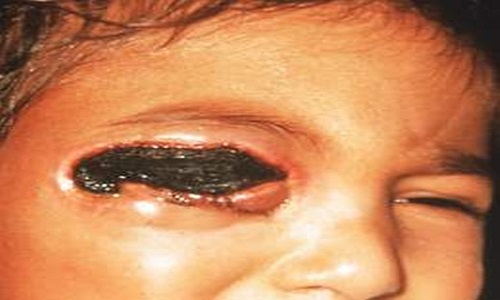 Bệnh than do dê cừu truyền: Những ai tiếp xúc với động vật bị bệnh hay các sản phẩm của chúng sẽ bị lở loét, sưng tấy, sốt, nhiễm độc máu và có thể dẫn tới tử vong. Căn bệnh này từng xảy ra thành đại dịch và giết chết rất nhiều người trên thế giới.