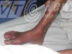 Chủ quan đắp lá: Chân khô héo phải cưa cụt