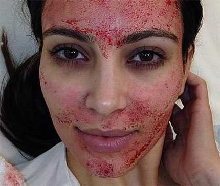 Kinh dị ảnh người mẫu bơm máu làm đẹp mặt