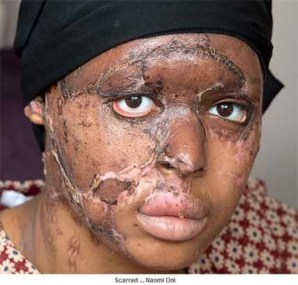 Quặn lòng vì axit, từ cô gái dễ thương thành xấu xí