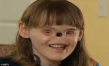 Xót xa nữ sinh 16 tuổi không mắt không mũi