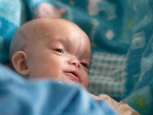 Cứu sống bé trai mặt bị chẻ làm hai