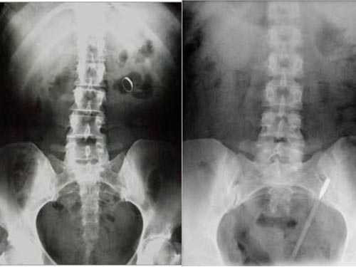 Khó tin những ca dị vật mắc trong cơ thể
