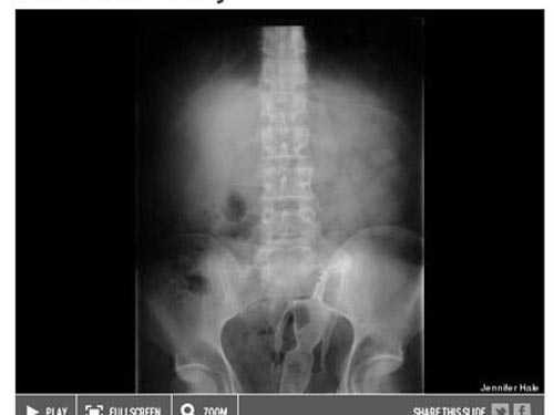 Khó tin những ca dị vật mắc trong cơ thể