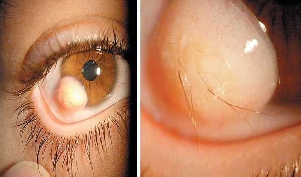 Kì quái chàng thanh niên mọc tóc trong mắt