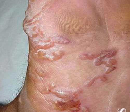 Kinh hãi bệnh nhân bị giun bò lúc nhúc dưới da bụng