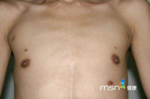 Kỳ lạ chàng trai mọc tới... 7 núm vú