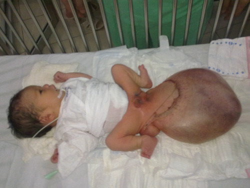 Người 2 đầu xuất hiện nhiều: Có thể do mẹ nhiễm virut