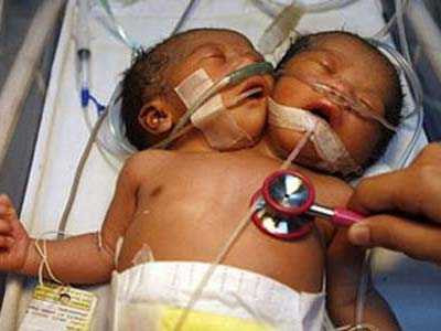 Người 2 đầu xuất hiện nhiều: Có thể do mẹ nhiễm virut