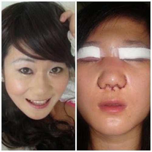 Một cô gái dấu tên người Trung Quốc bị biến dạng khuôn mặt vì quyết tâm dùng dao kéo để có được vẻ đẹp hoàn hảo hơn.