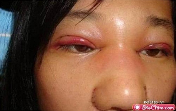 Mí mắt bị sưng lên và hỏng hoàn toàn.