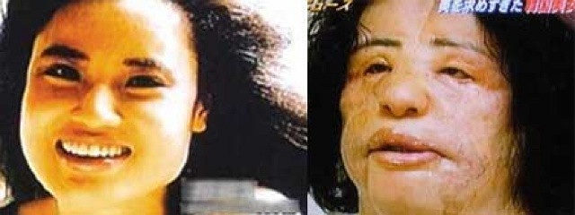 Hang Mioku, người Hàn Quốc, 48 tuổi, phẫu thuật lần đầu tiên vào năm 28 tuổi. Kể từ đó cô chuyển đến sống tại Nhật Bản để tiện thỏa mãn cơn nghiện phẫu thuật, hầu hết là trên mặt. Khuôn mặt của Hang biến dạng tới mức tất cả các bác sĩ phẫu thuật cô g