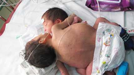 Sửng sốt thương những đứa trẻ 2 đầu, 4 tay