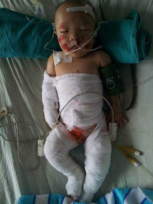 Thương tâm bé 6 tháng tuổi bỏng 50% vì trời lạnh