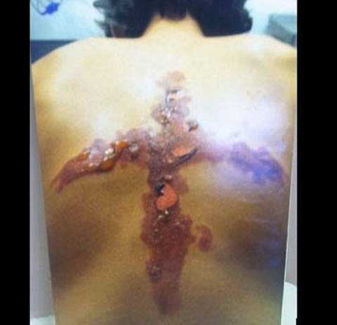 Tự làm bỏng bằng đá và muối, thú vui nguy hiểm của teen