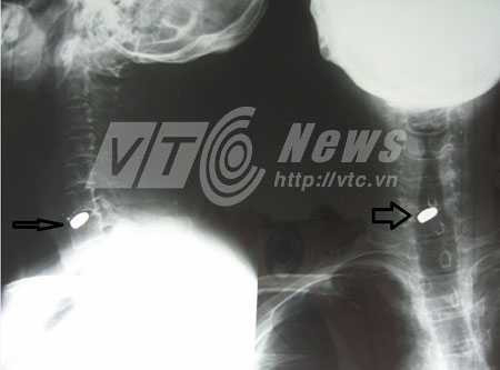 Tưởng súng bút là đồ chơi, nhiều người suýt chết