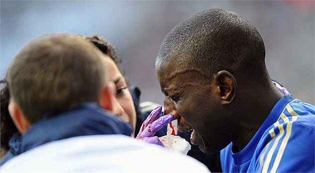 Mục đích là bảo vệ chiếc mũi bị gãy của anh, sau khi nó bị va chạm rất mạnh trong trận đấu với Newcastle