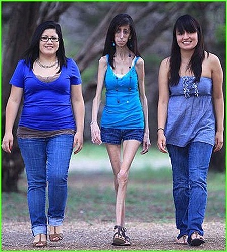 Lizze Velasquez 23 tuổi mà chỉ nặng 26kg