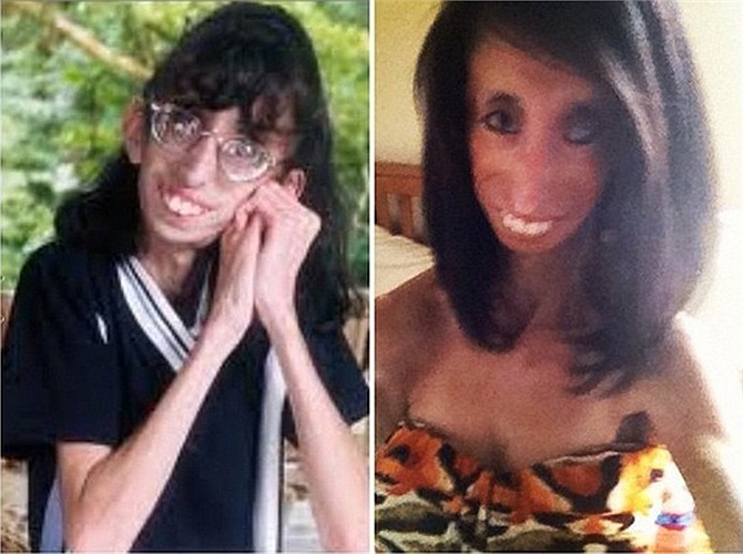 Người mắc chứng bệnh này sẽ già nua, gầy gò, da nhăn nheo và rất xấu xí