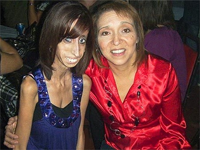 Dù ăn đến 60 bữa nhỏ một ngày, Lizze Velasquez vẫn không thể béo lên, cô còn bị mù một mắt