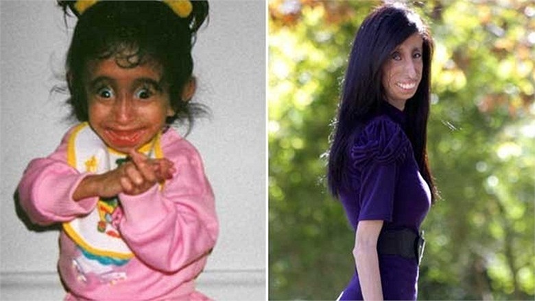 Lizze Velasquez khi còn là một đứa trẻ (trái)và khi đã trưởng thành 