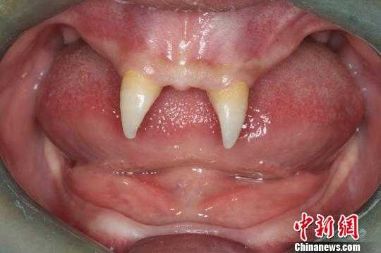 Cậu bé 'ma cà rồng' 16 tuổi chỉ mọc 2 răng nanh