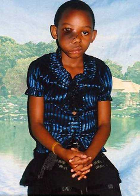 Đáng thương bé gái với khối u khổng lồ trên mặt