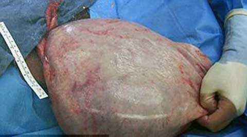 Khối u trong bụng, bé gái 12 tuổi bị 'kết tội' có thai