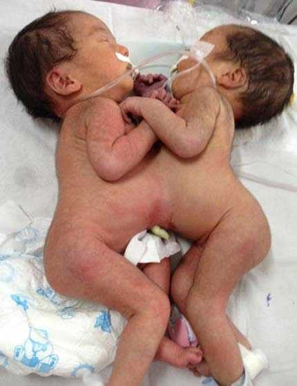 Ngay mai phẫu thuật cặp bé gái song sinh dính liền