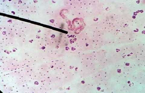 Loại kí sinh trùng sán lá ruột lớn có tên Fasciolopsis Buski Loại kí sinh trùng sán lá ruột lớn có tên Fasciolopsis Buski