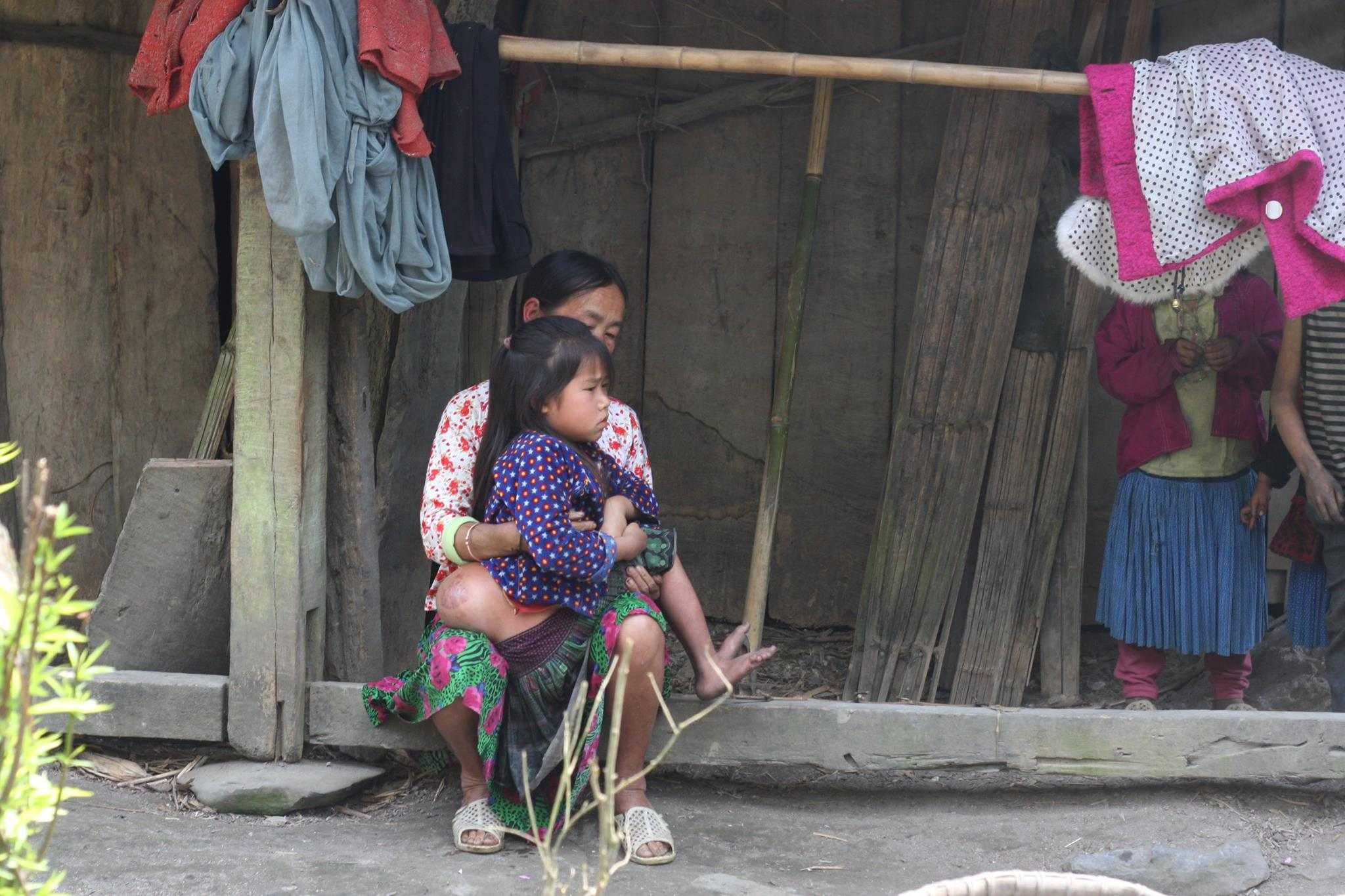 Ảnh: Bé gái 'người vượn' cõng khối u khổng lồ sợ sệt bò chạy khi thấy người lạ