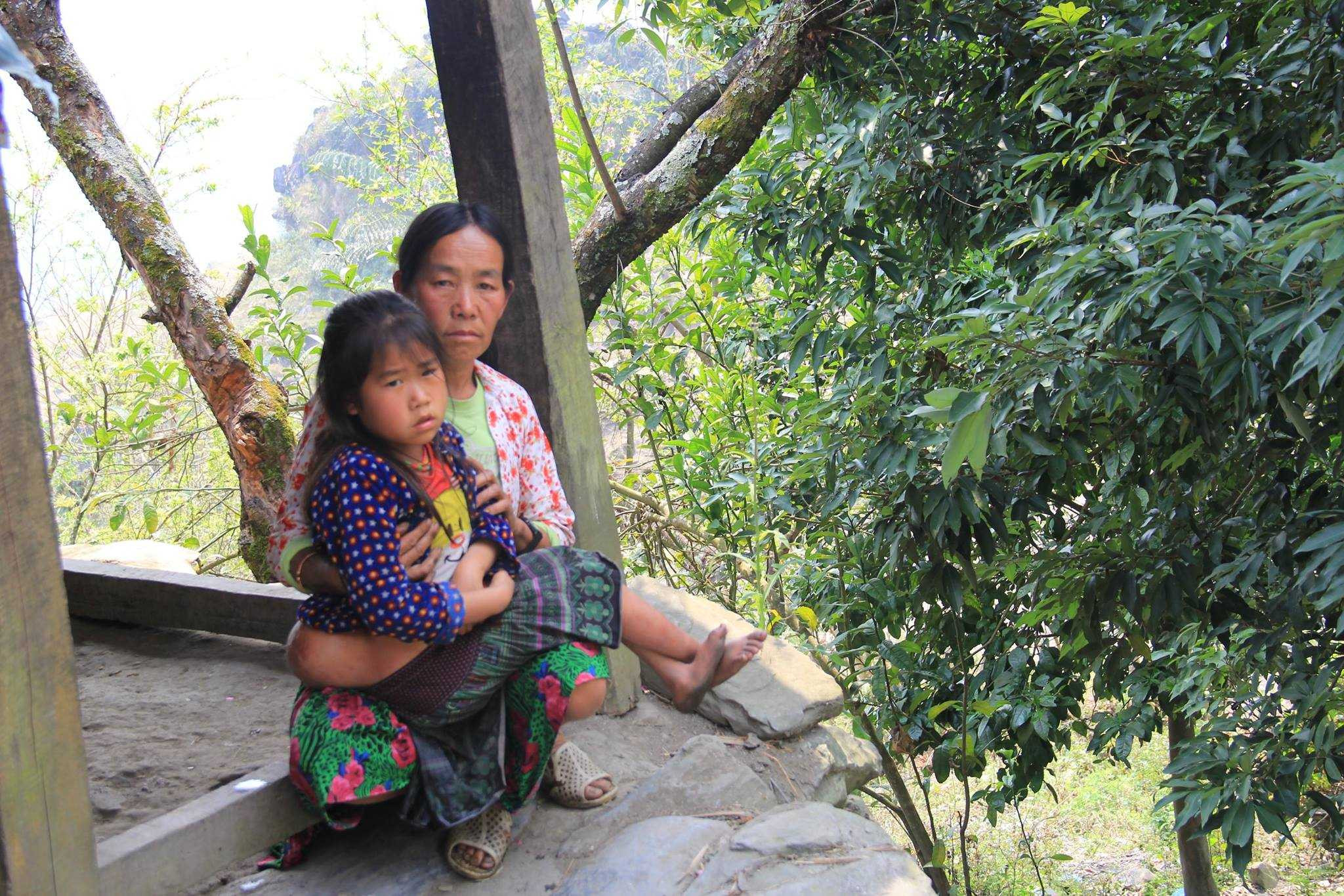 Ảnh: Bé gái 'người vượn' cõng khối u khổng lồ sợ sệt bò chạy khi thấy người lạ