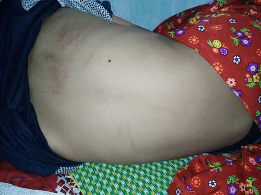 Vết mèo cào trên lưng cháu H Vết mèo cào trên lưng cháu H